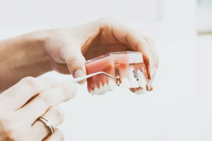 インプラントの画像